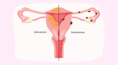 Endometriosis and Adenomyosis